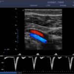 11. Popliteal Artery_ PW