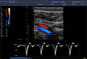 11. Popliteal Artery_ PW