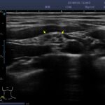 11. subclavian brachial plexus