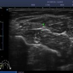 12. median nerve transverse section