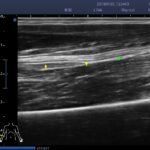 13. median nerve