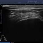 14. Supraspinatus