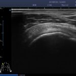 15. Supraspinatus