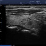 15. Thyroid Nodule