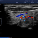 16. Thyroid Nodule_color