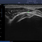 17. tendon of long head of biceps brachii