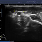 18. axillary nerve