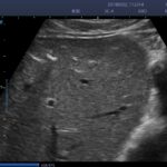 2. Calculus of intrahepatic duct