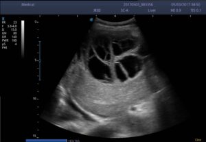 2. Hepatic echinococcosis