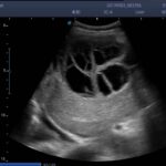 2. Hepatic echinococcosis