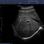 2.calculus of intrahepatic duct