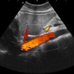 3. Aorta_CFM