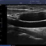 4. Carotid