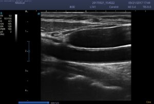 4. Carotid