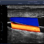 4. Carotid_CFM