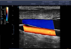 4. Carotid_CFM