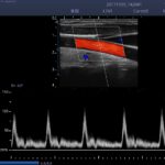 4. Carotid_PW