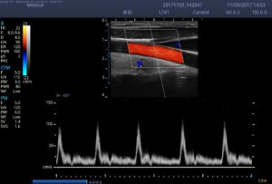 4. Carotid_PW