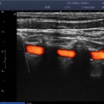 5. Vertebral Artery