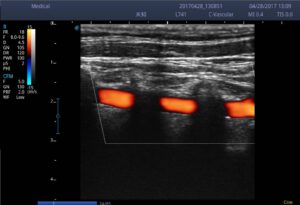 5. Vertebral Artery