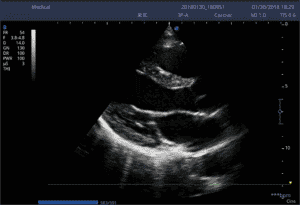 6. LV Longitudinal View