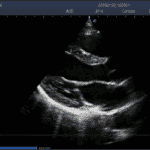 6. LV Longitudinal View