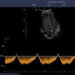 6. hepatic vein_PW