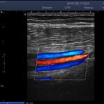 7.Posterior Tibial Artery and Vein