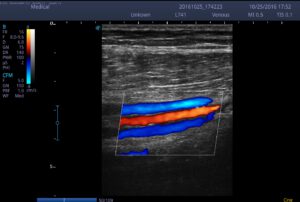 7.Posterior Tibial Artery and Vein