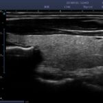 8. Thyroid longitudinal section